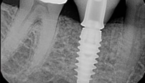 X ray of dental implant in jawbone