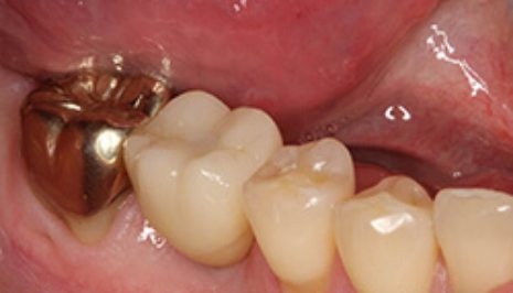 Close up of gold dental crown in mouth