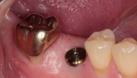Close up of mouth with gold dental crown next to dental implant abutment
