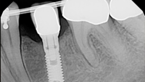 X ray of a dental implant in the jawbone