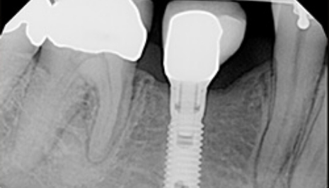 X ray of a patient with a dental implant in their jaw