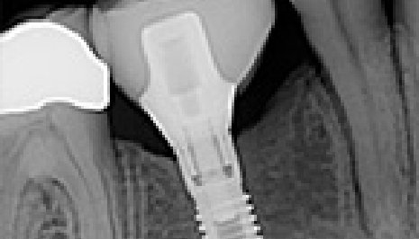 Zoomed in X ray of a patient with a dental implant