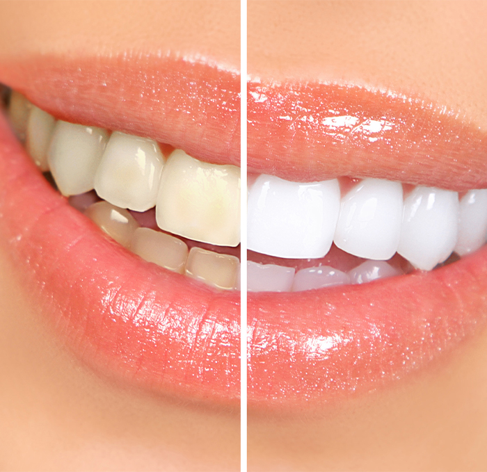 Close up of smile before and after teeth whitening in Brandon