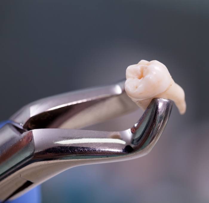 Dental forceps holding a tooth after a tooth extraction in Brandon