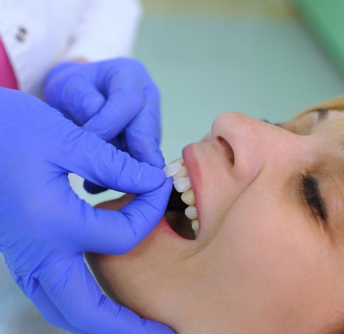 Dentist placing a veneer over the front tooth of a patient