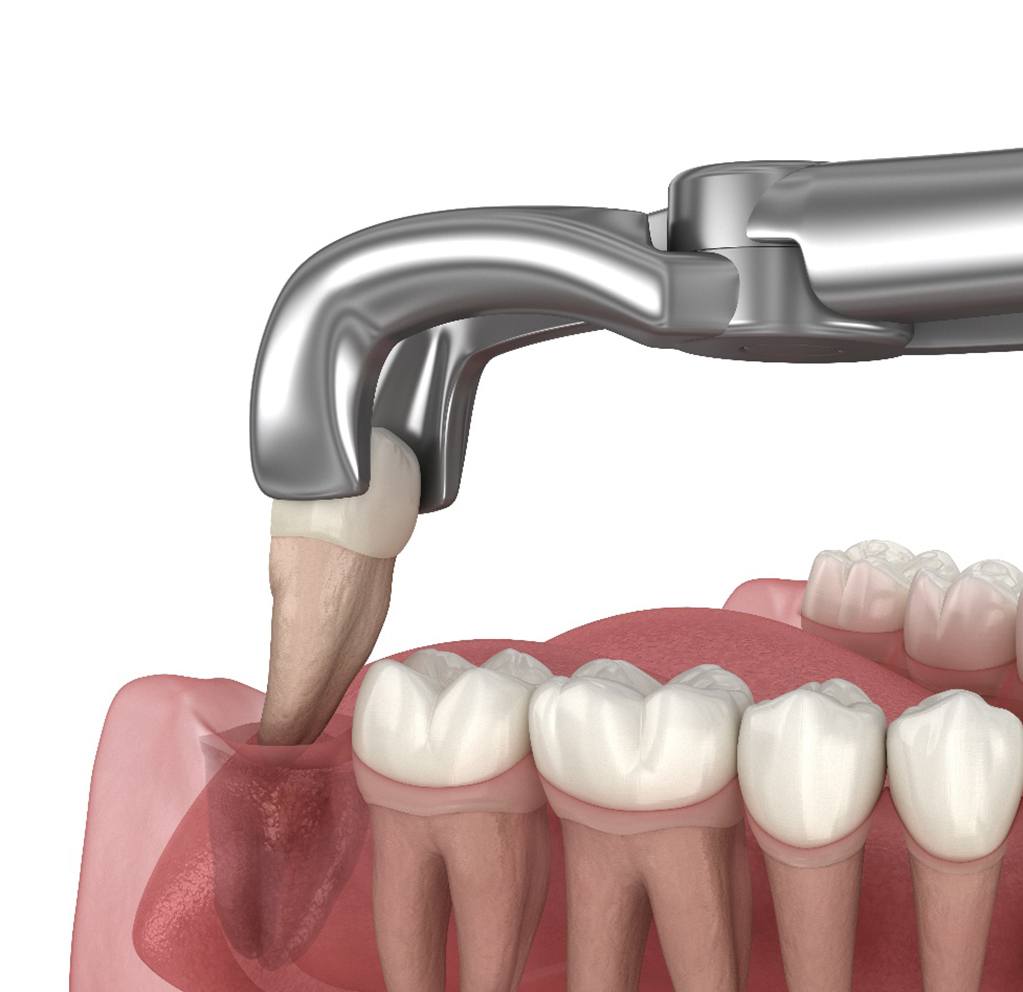 A digital image of a wisdom tooth being removed