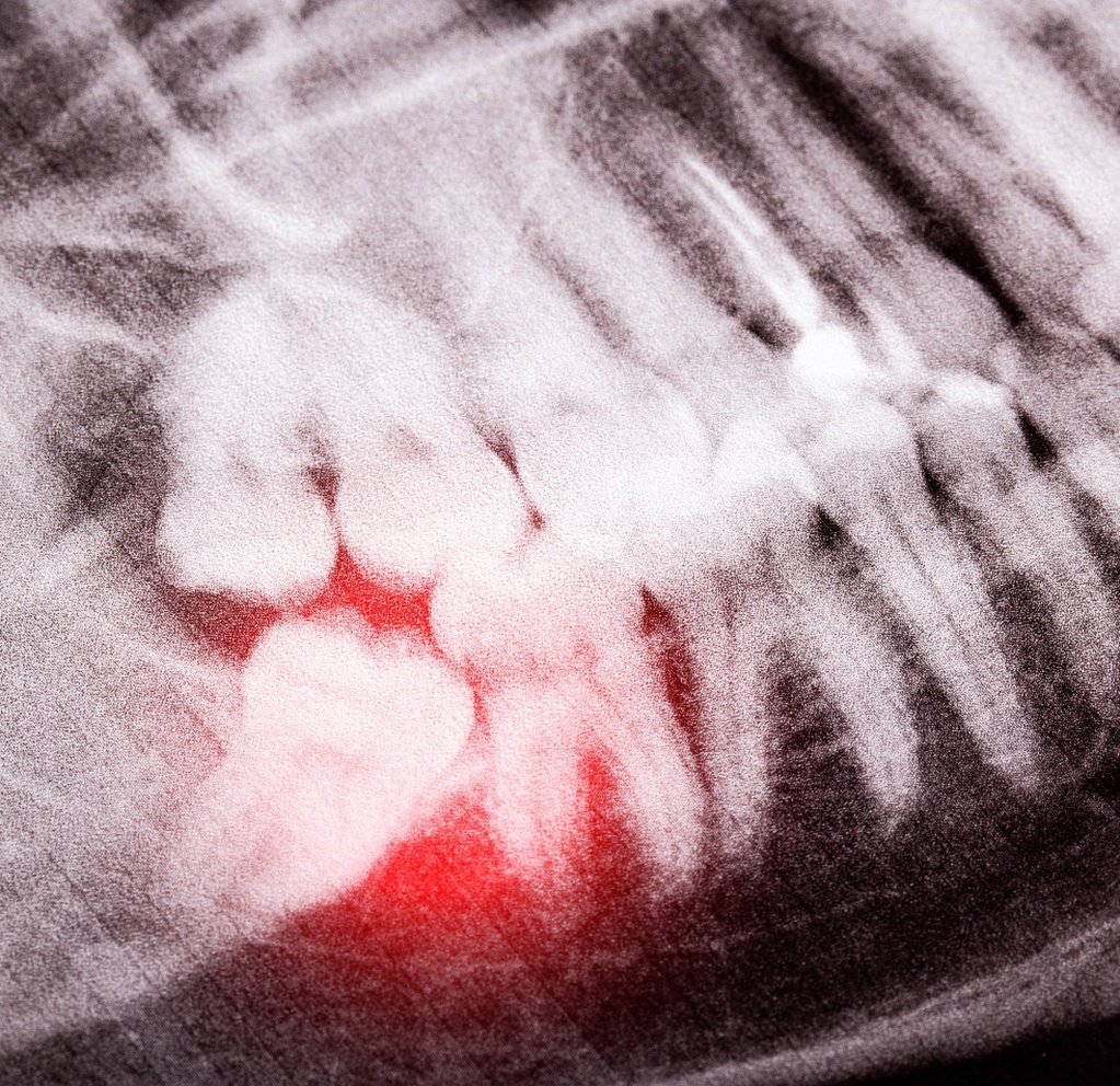 X-ray of a partially erupted and misaligned wisdom tooth