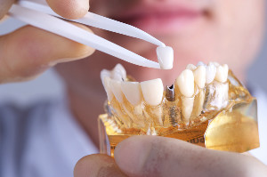 Dental implants in Brandon complete smiles