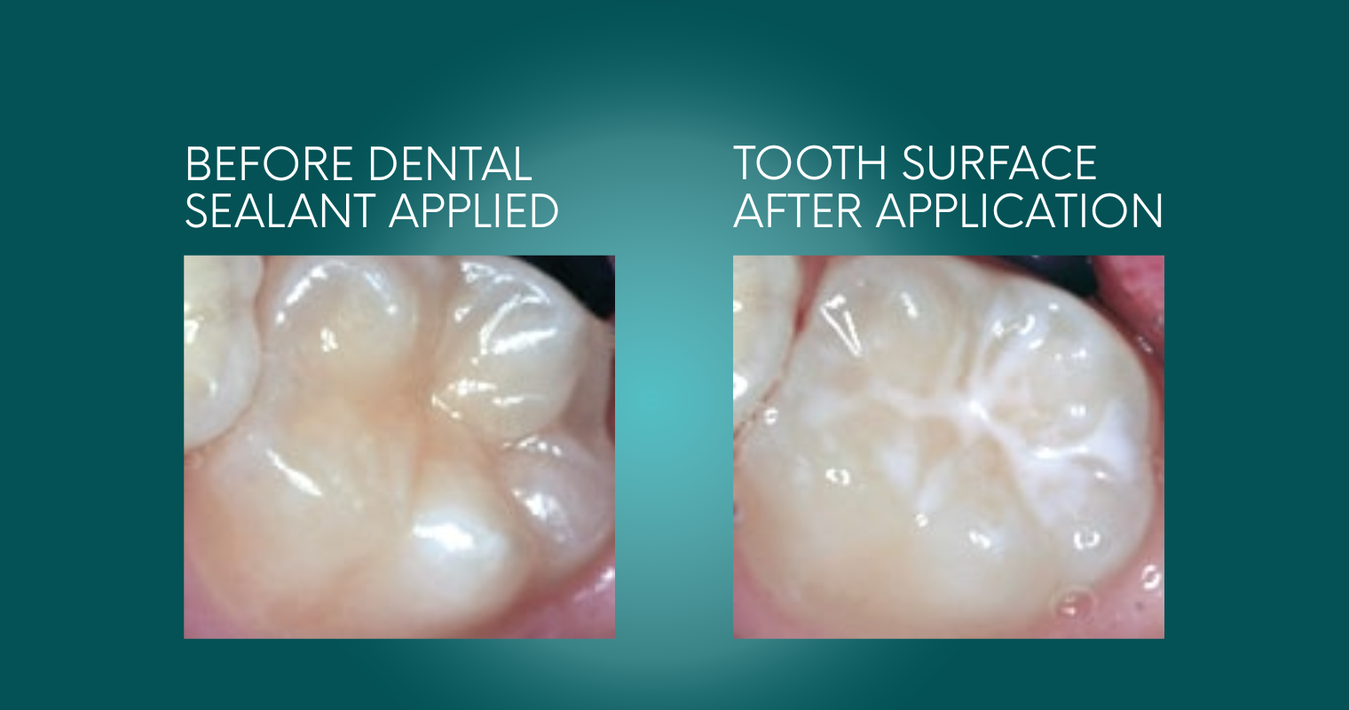 Before And After Dental Sealant Treatment